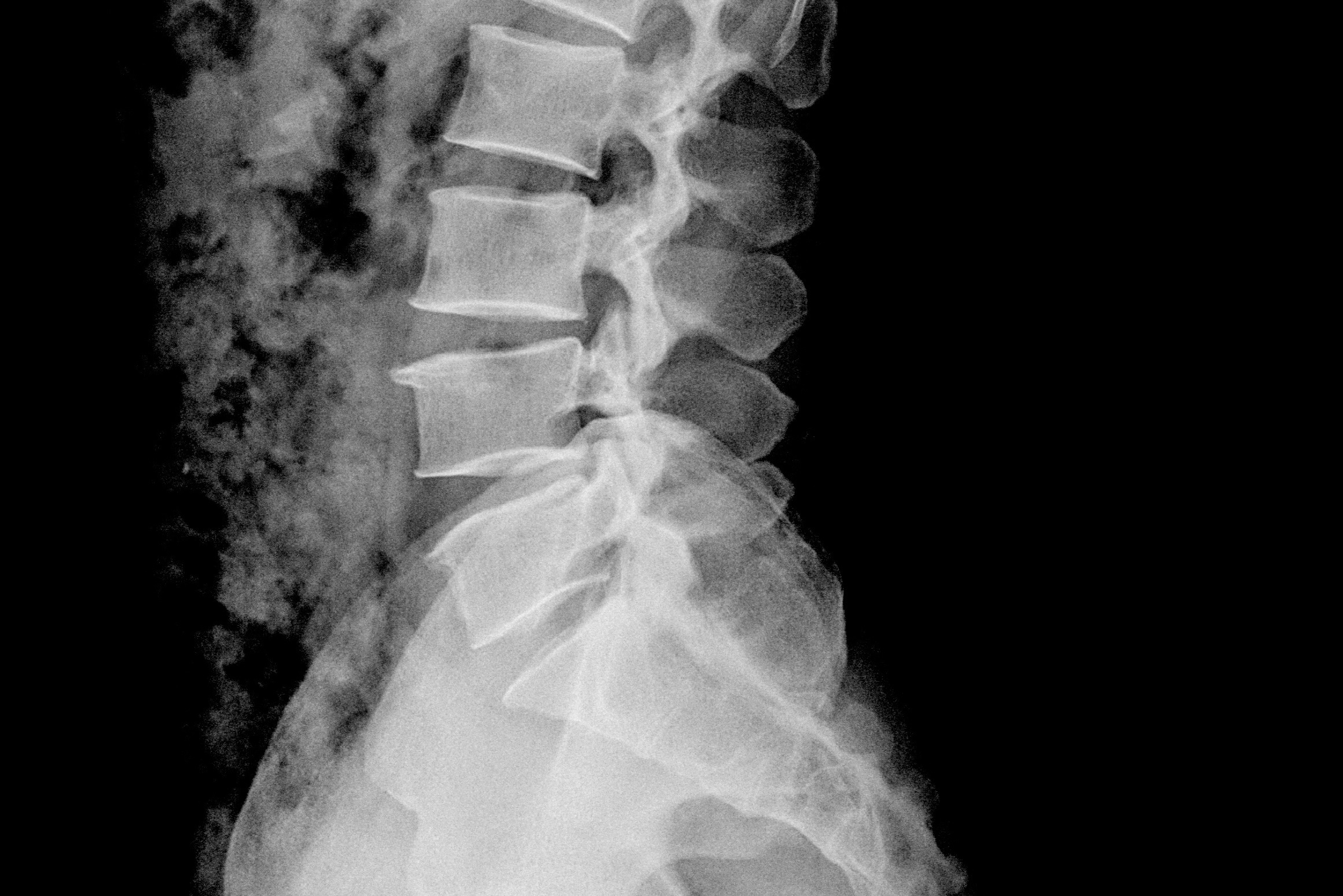 x-ray of human lumbar spine